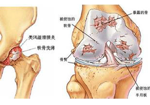 同时其它组织和细胞也可以生化为滑膜细胞