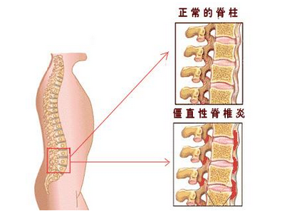 福州强直性脊柱炎要怎么预防