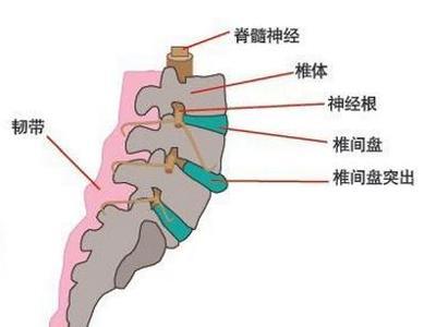 腰椎间盘突出的检查方法有哪些