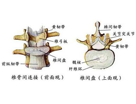 腰椎间盘突出的七大危害