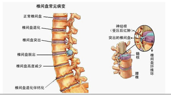 诱发腰椎间盘突出