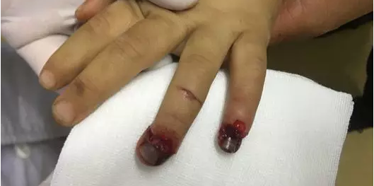 福州手指被绞伤去哪个医院好