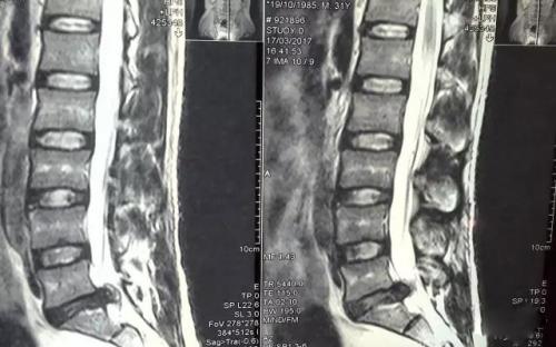 福州看腰椎间盘突出哪个医院好