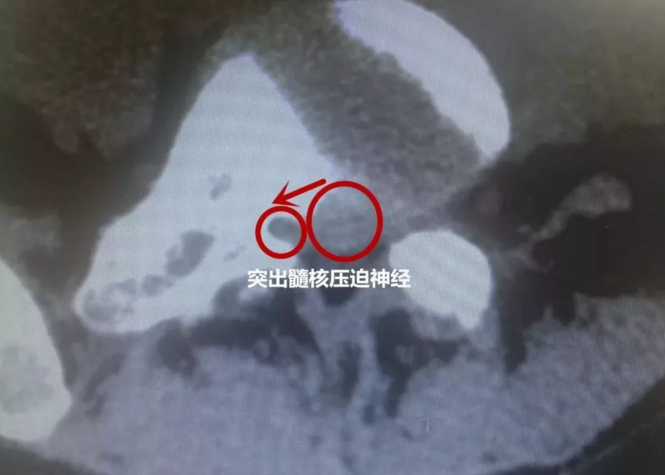 福州治疗腰椎间盘突出去哪家医院好